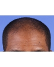 Before Hair Transplant &nbsp;Front